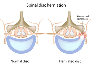 02_hernia2