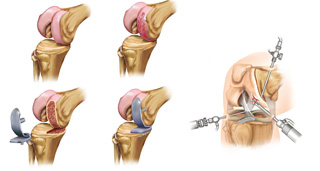 03b_uni_rodilla_0