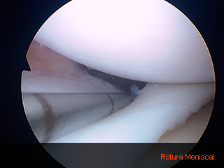 04_artroscopia_rodilla_02