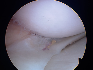 04_artroscopia_rodilla_05