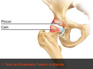 07-1-cfa-pinzamientos